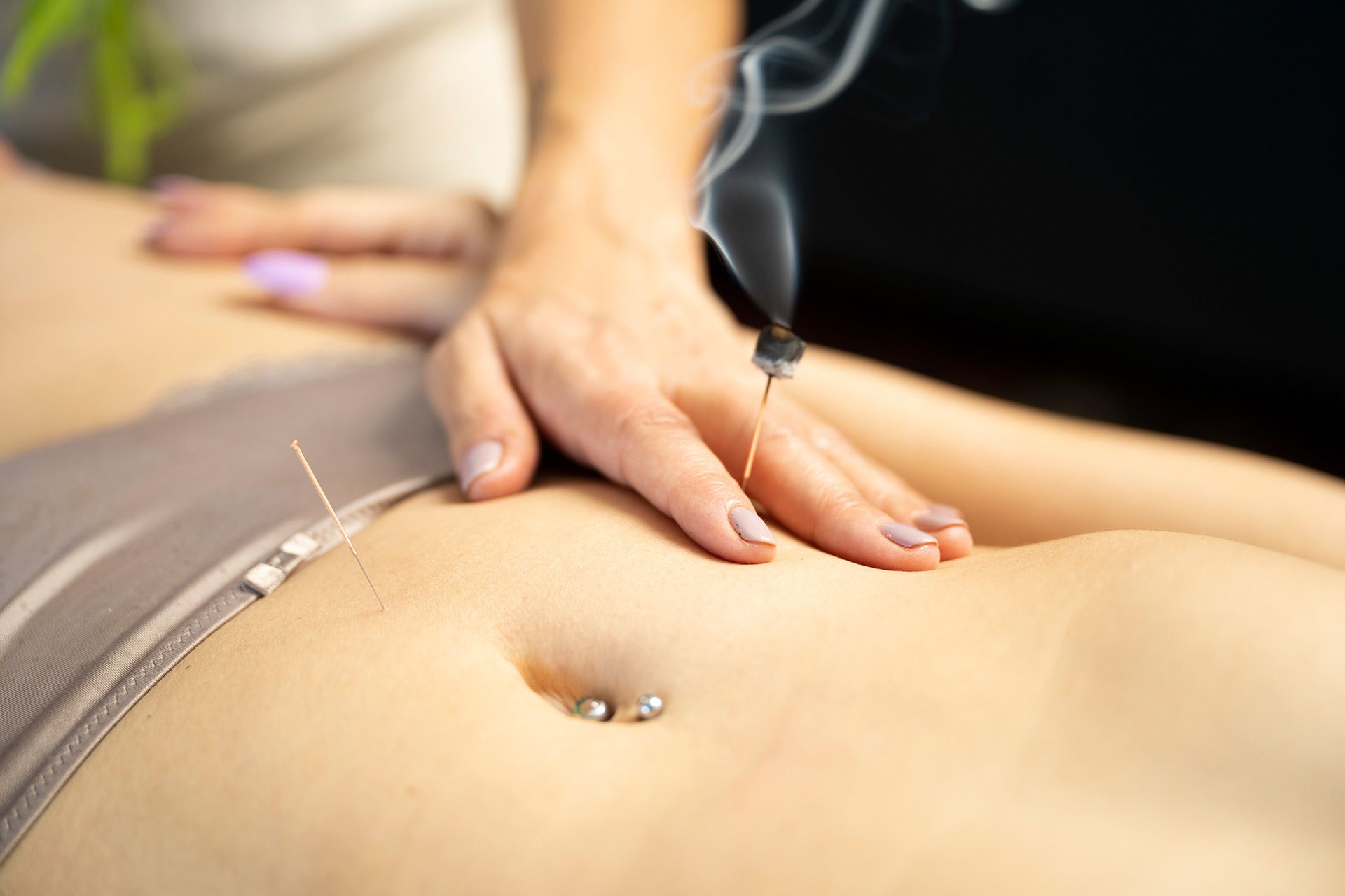 Acupuncture