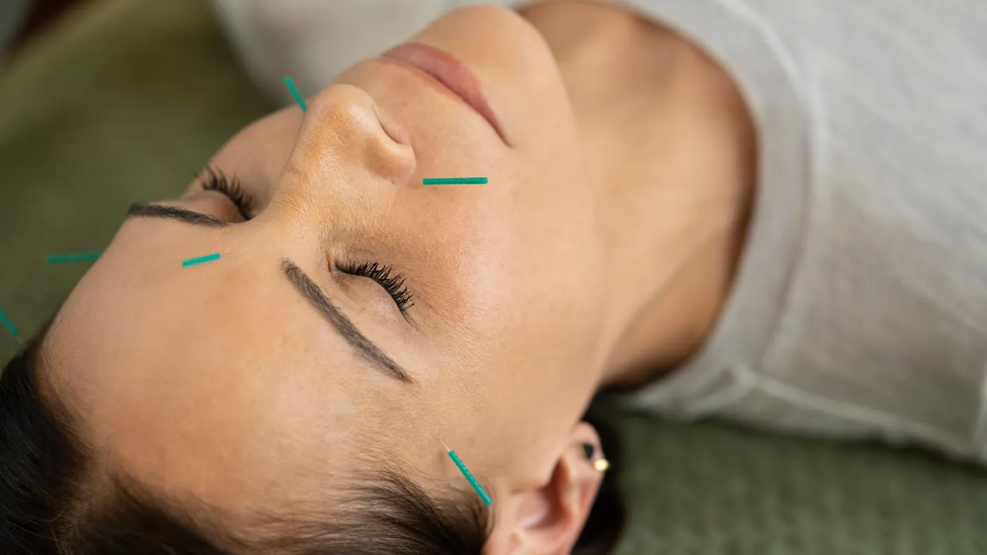 Acupuncture treatment in progress at Body Perfected, Marylebone
