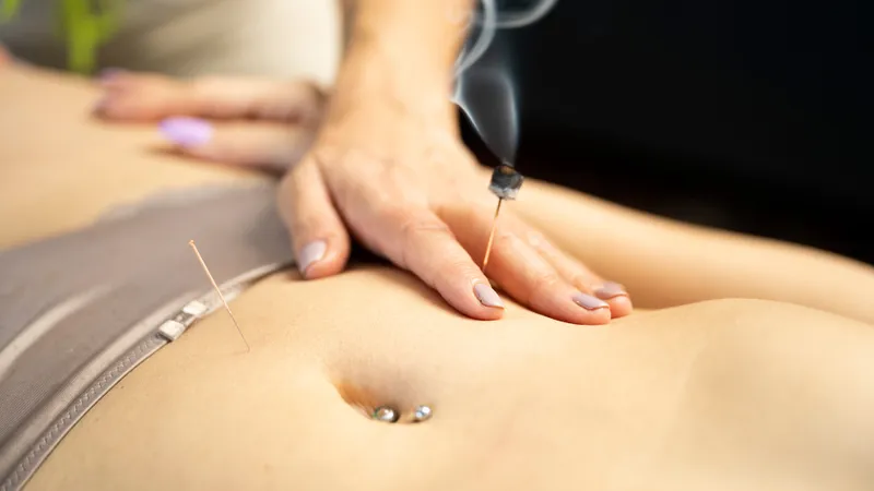 Acupuncture treatment in progress at Body Perfected, Marylebone