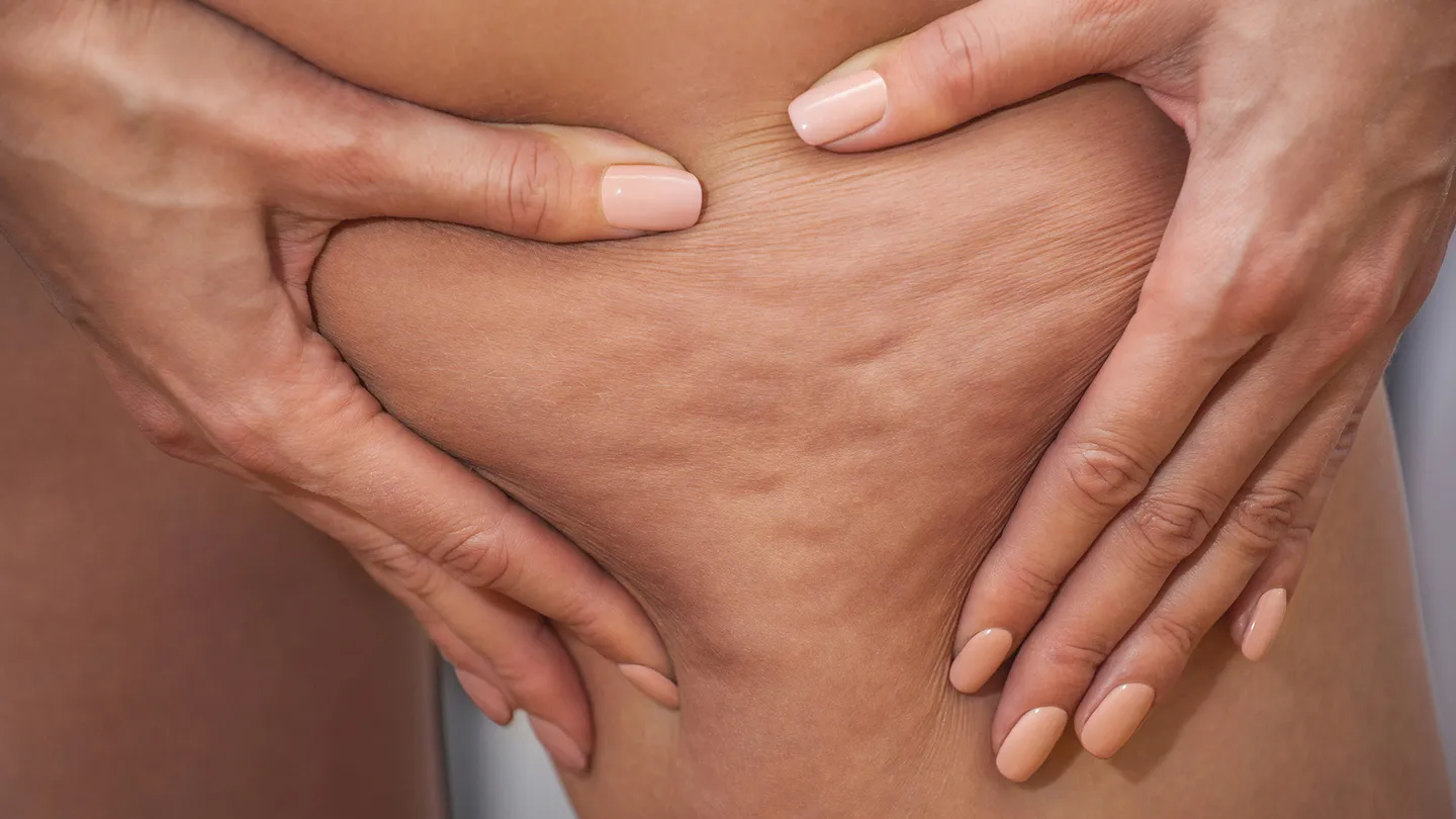 Lipoedema management session at Body Perfected, Marylebone