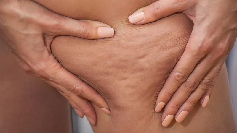 Lipoedema management session at Body Perfected, Marylebone