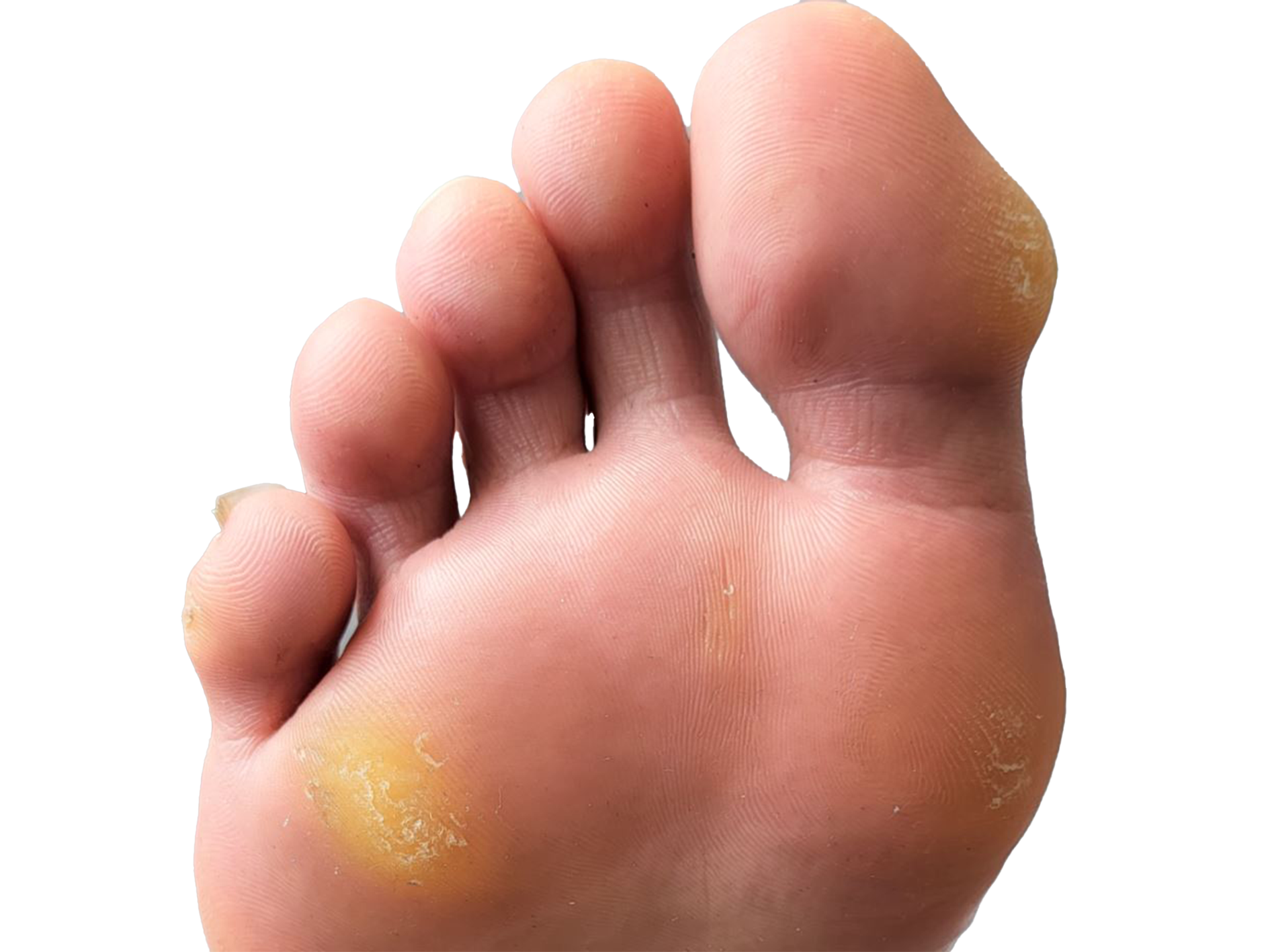 Callus & Hard Skin