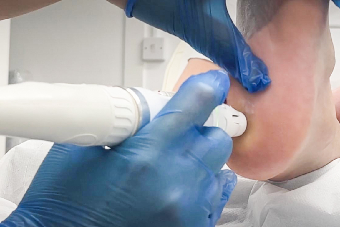 Verruca Treatment