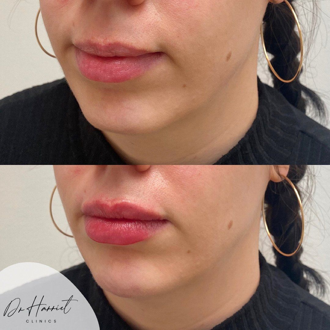 Natural filler result by Dr Harriet Turnbull at UNTIL Marylebone