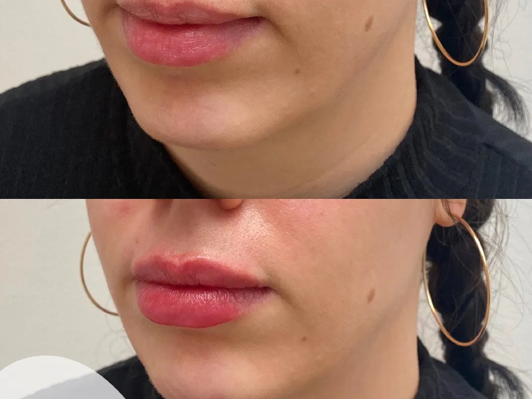 Facial Volume Loss