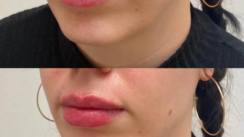 Facial Volume Loss