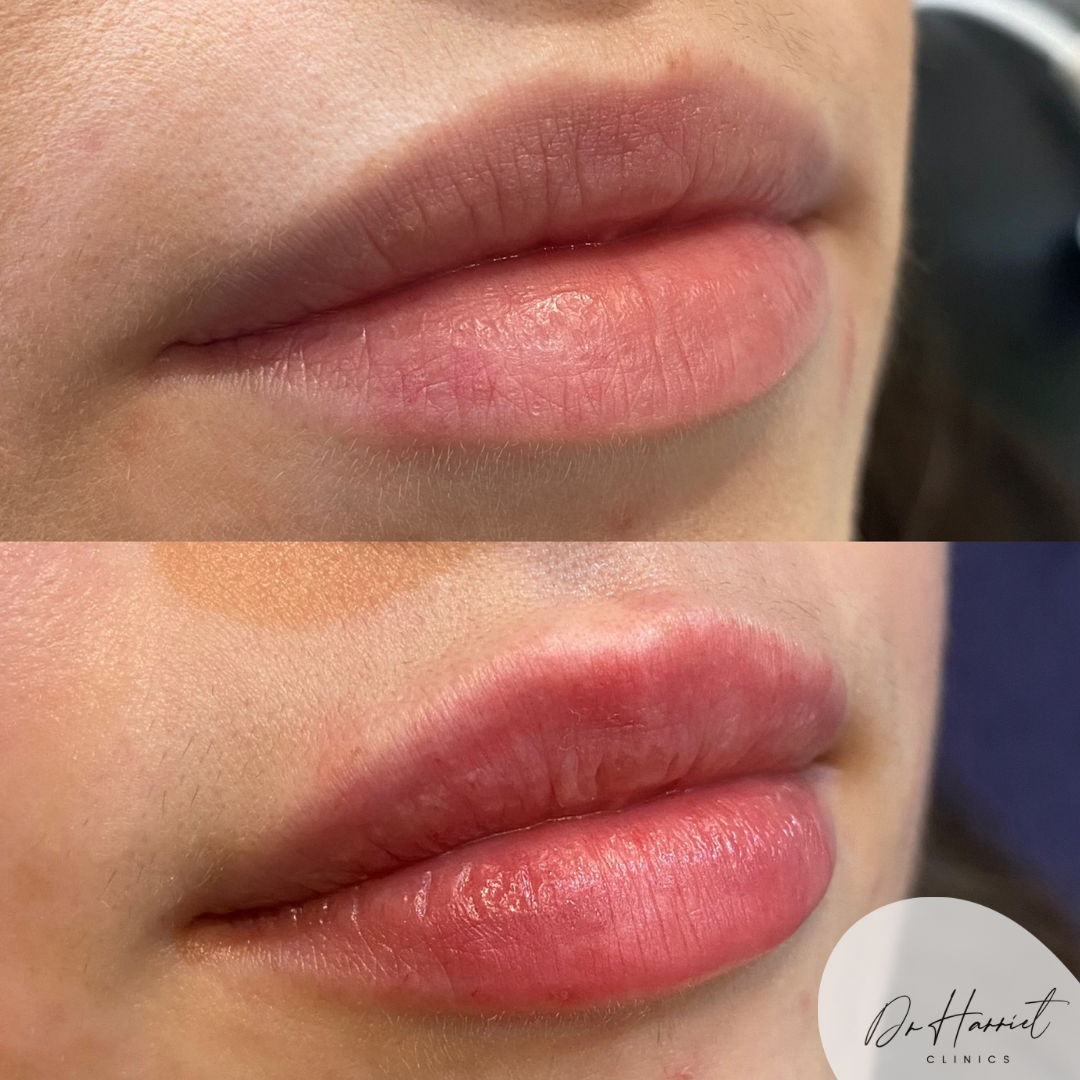 Natural lip filler result by Dr Harriet Turnbull