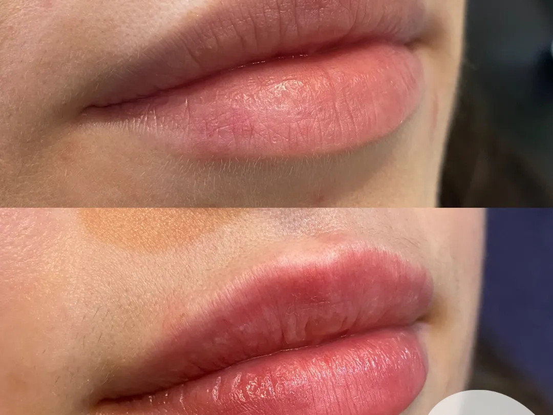 Natural lip filler result by Dr Harriet Turnbull