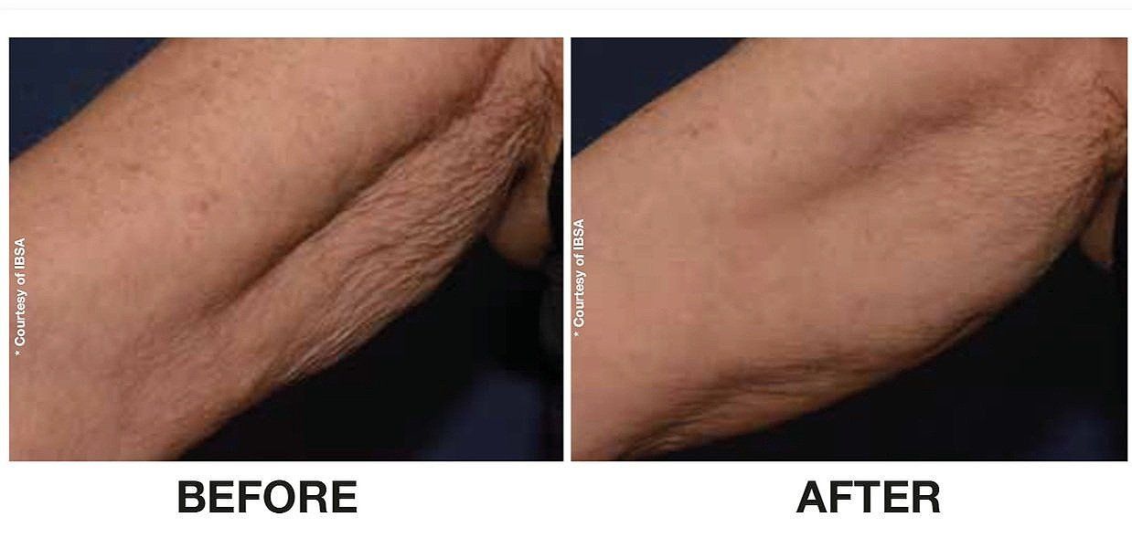 Profhilo BODY, arms