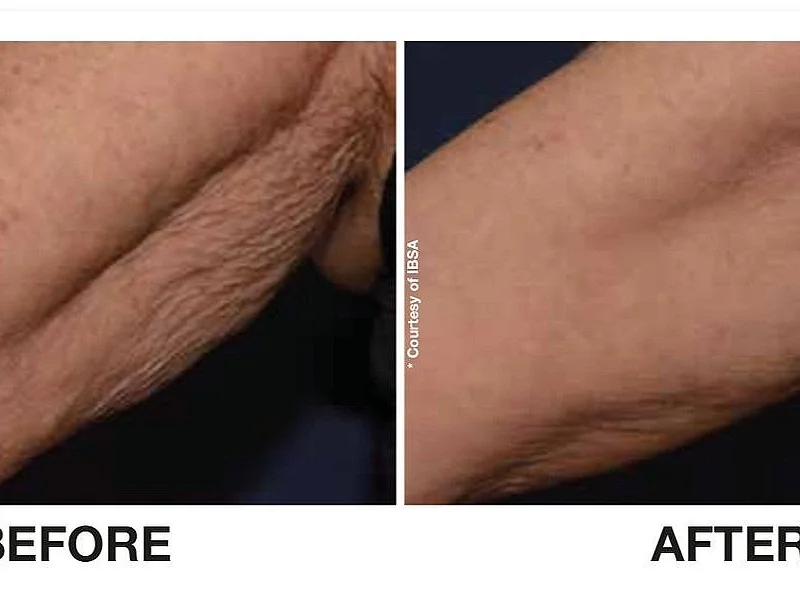 Profhilo BODY, arms