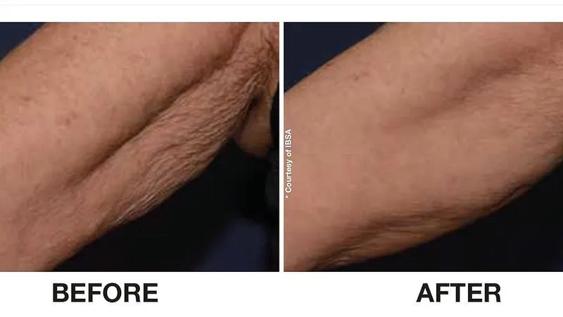 Crepey Skin