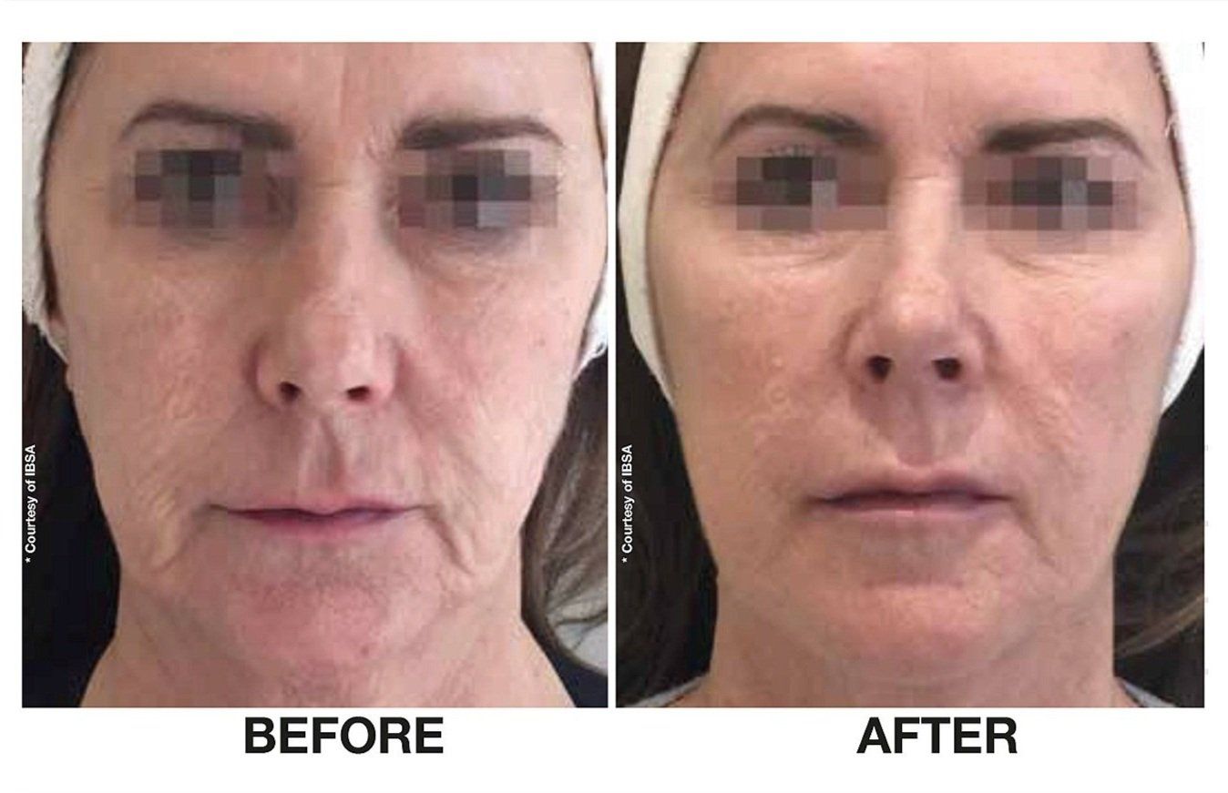 Profhilo, full face