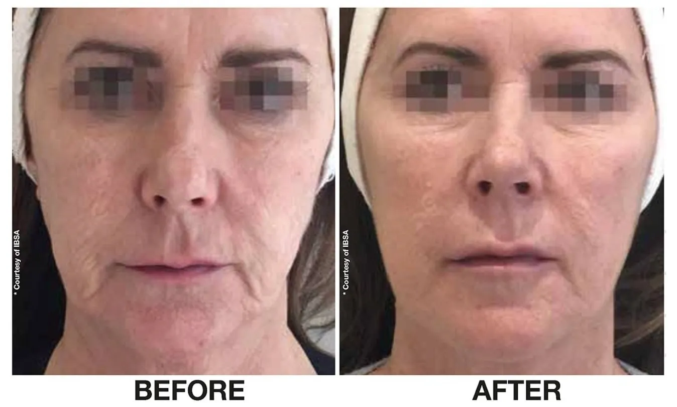 Skin Quality