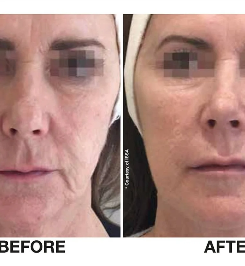 Profhilo, full face