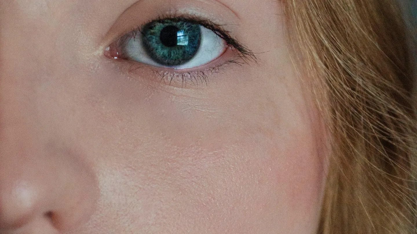 Tear Trough Shadows