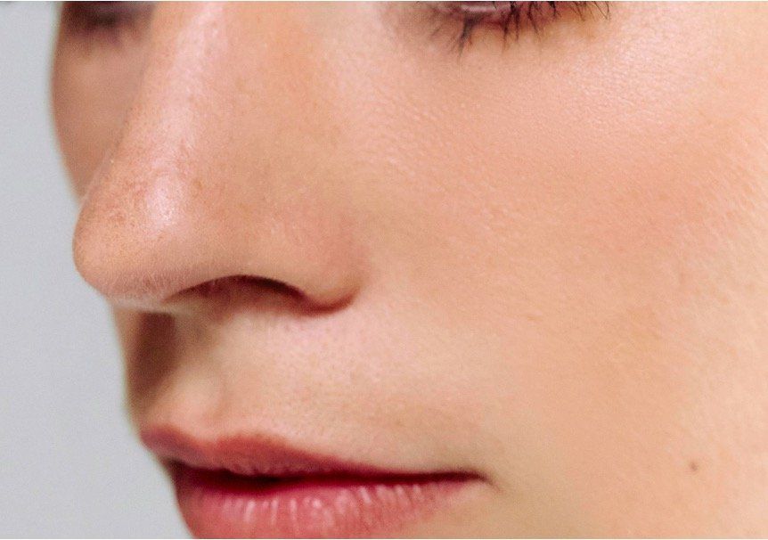 Feminising non-surgical rhinoplasty treatment area