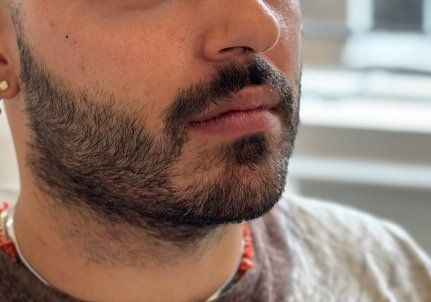 Masculinising lip definition treatment area