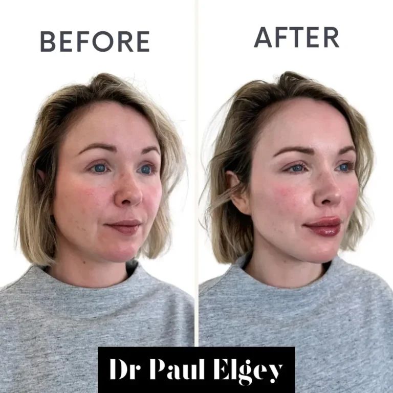 Cheek filler before and after result by Dr Paul Elgey, London