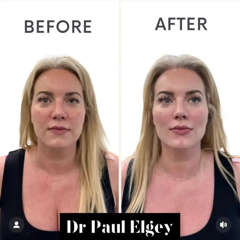 Cheek filler before and after result by Dr Paul Elgey, London