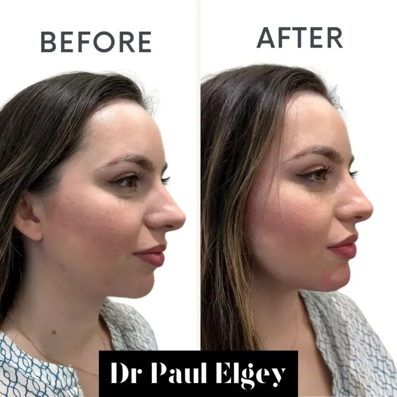 Chin filler before and after result by Dr Paul Elgey, London
