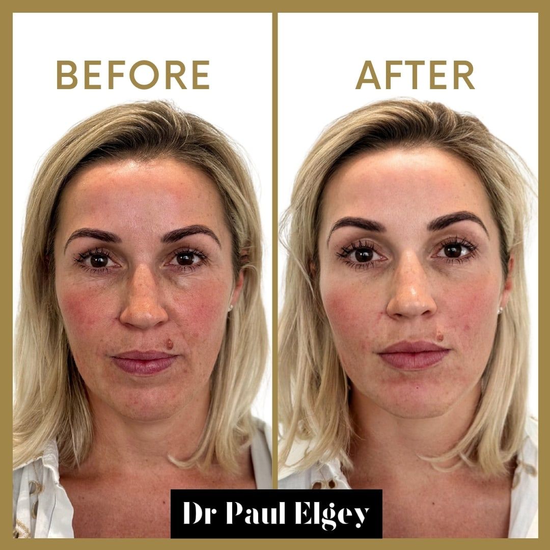 Before and after full face rejuvenation with Dr Paul Elgey, front view