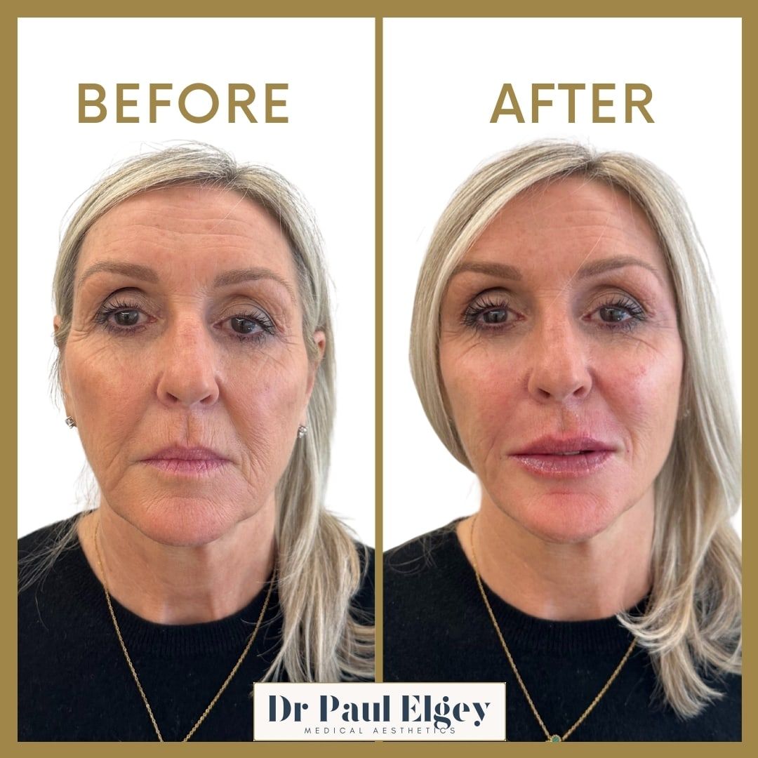 Before and after full face rejuvenation with Dr Paul Elgey, front view