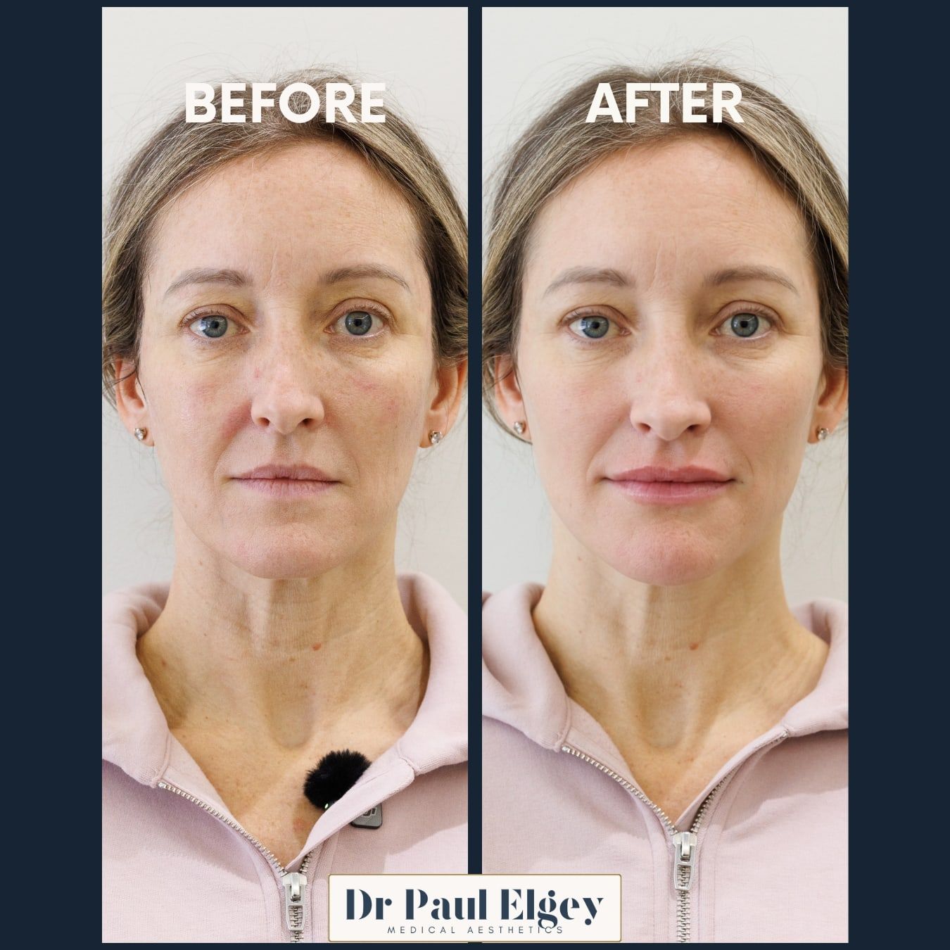 Before and after full face rejuvenation with Dr Paul Elgey, front view
