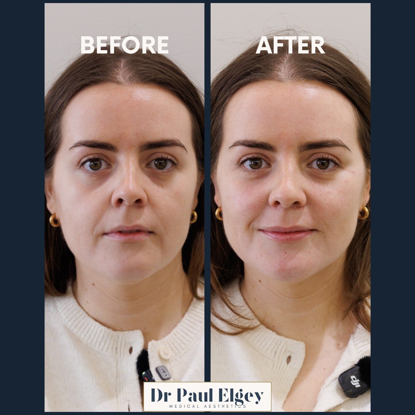 Before and after full face rejuvenation with Dr Paul Elgey, front view