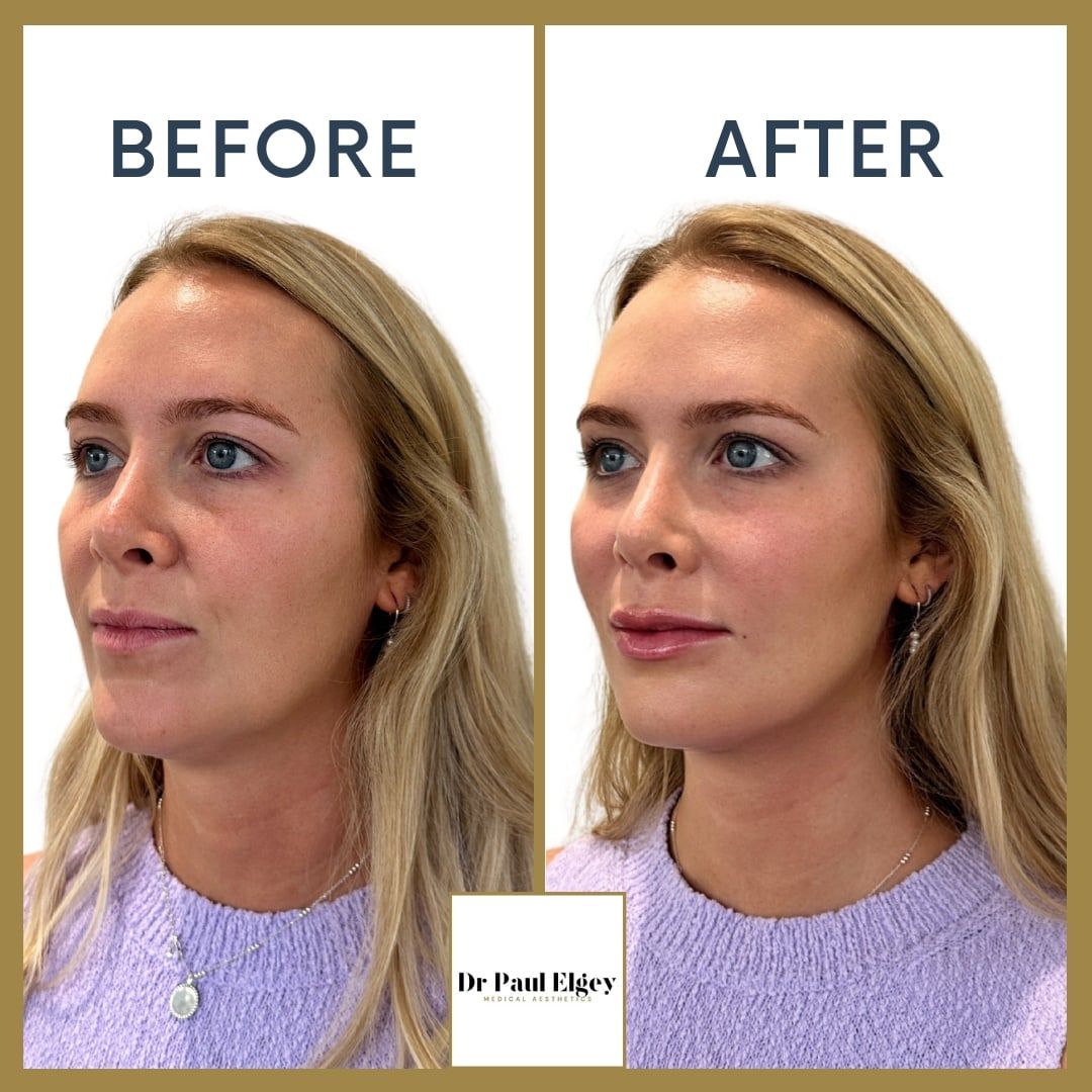 Before and after full face rejuvenation with Dr Paul Elgey, three-quarter view