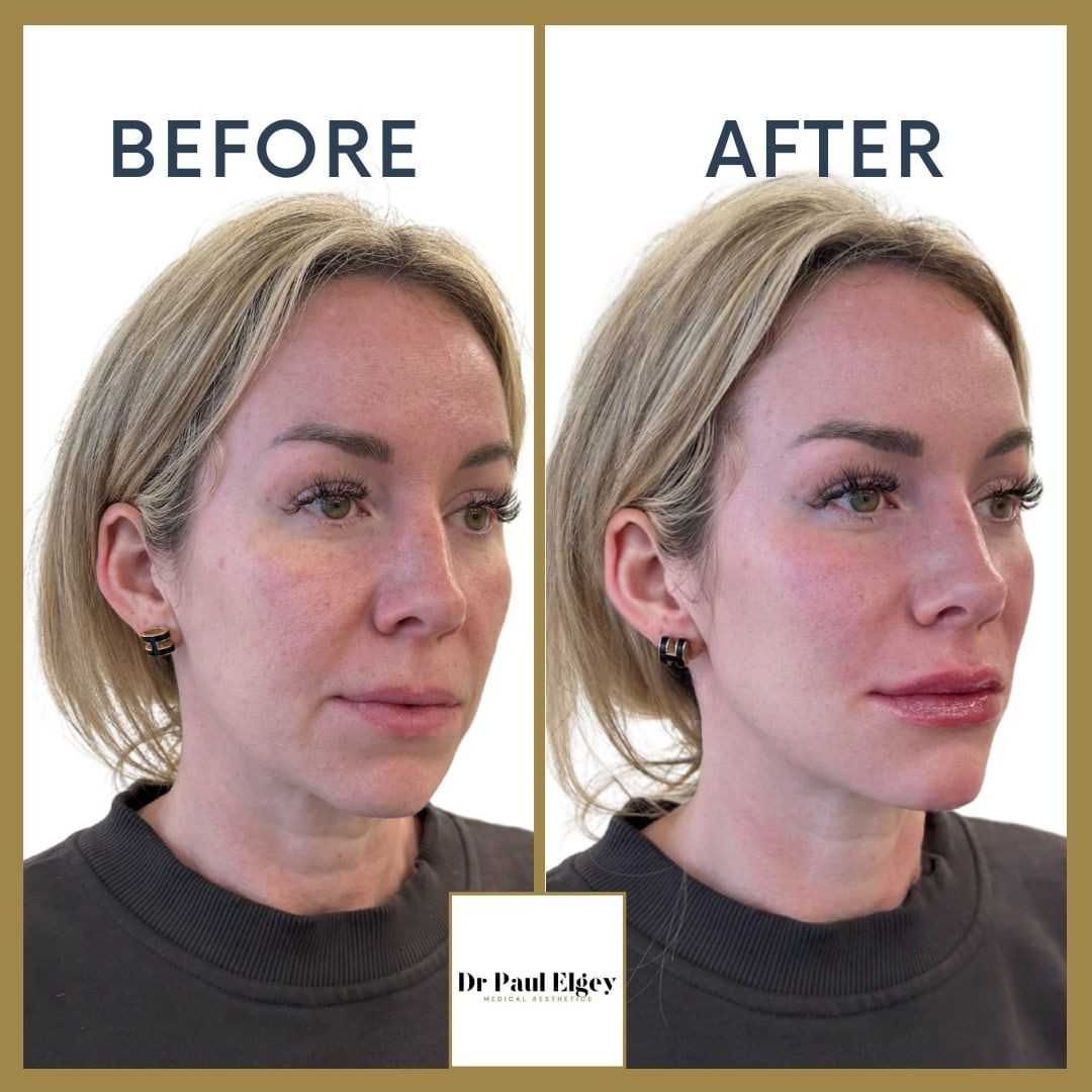 Before and after full face rejuvenation with Dr Paul Elgey, three-quarter view