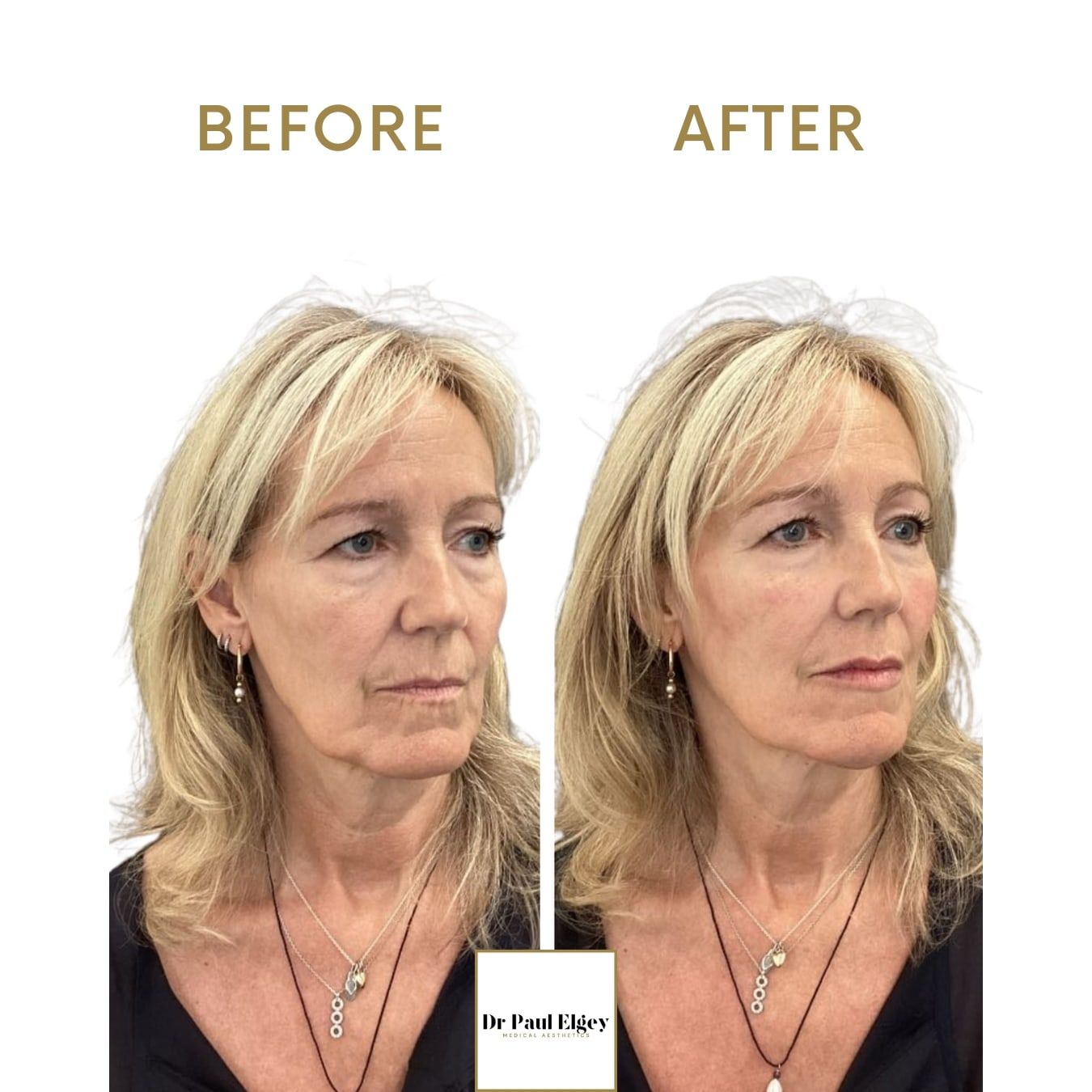 Before and after full face rejuvenation with Dr Paul Elgey, three-quarter view