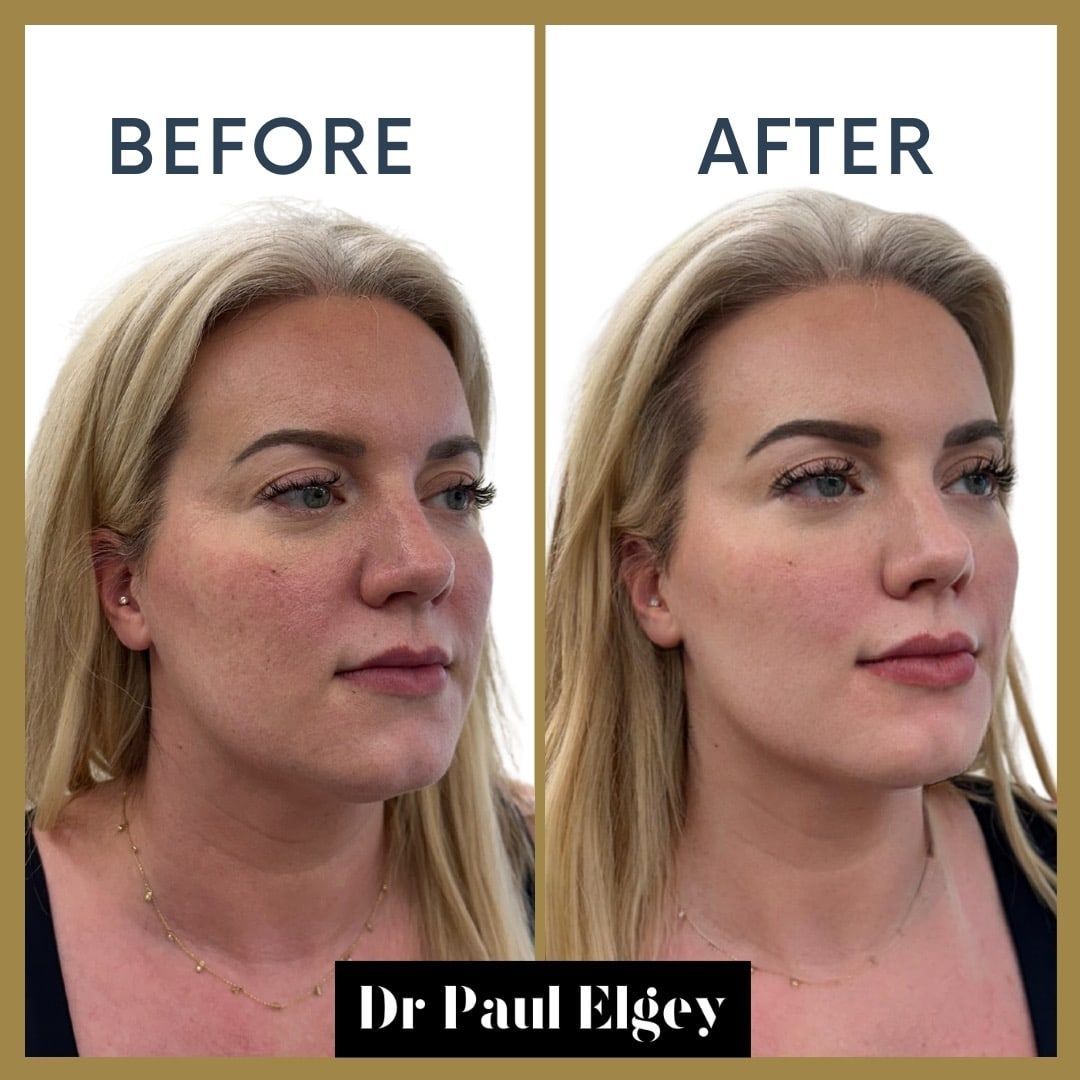 Before and after full face rejuvenation with Dr Paul Elgey, three-quarter view