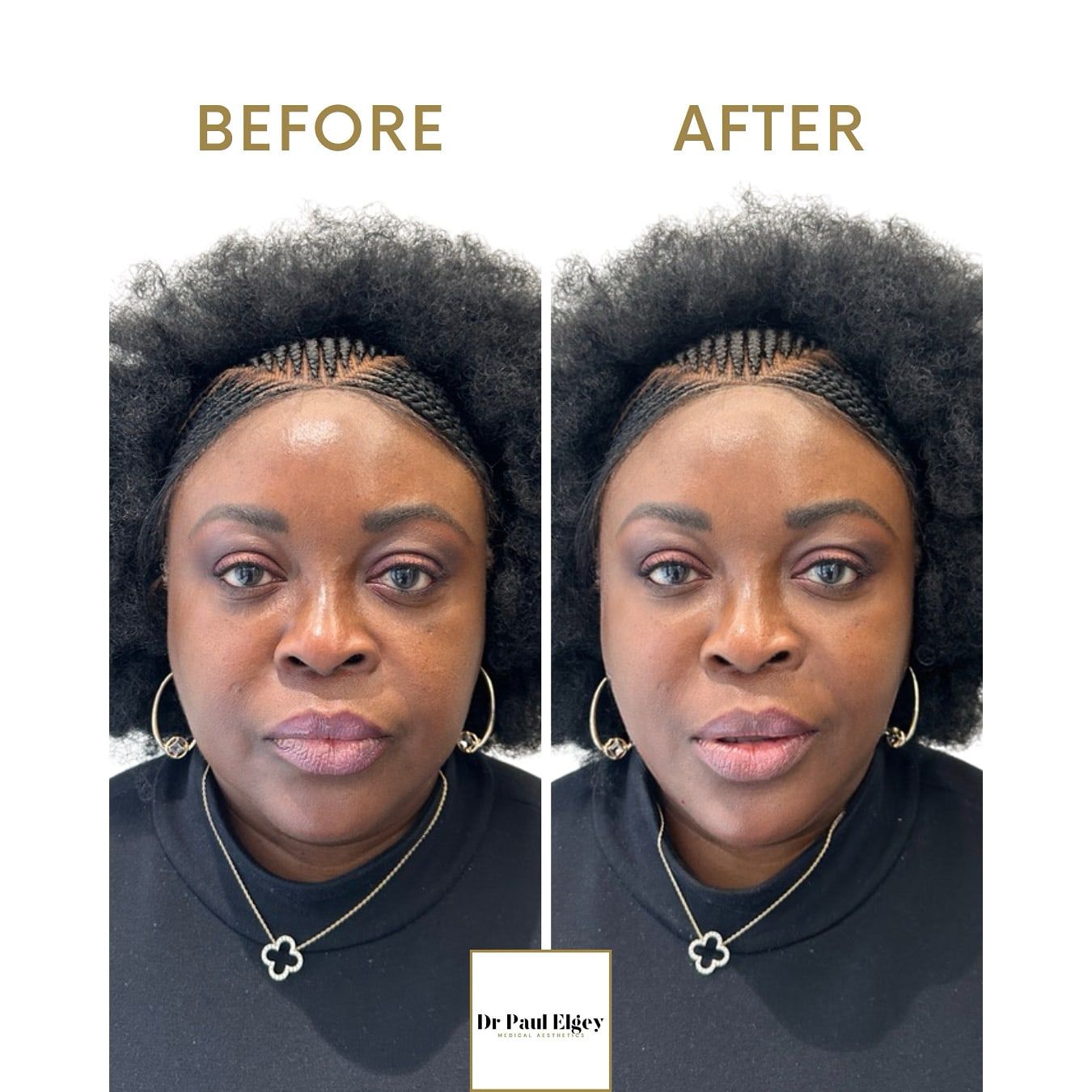 Before and after full face rejuvenation with Dr Paul Elgey, front view