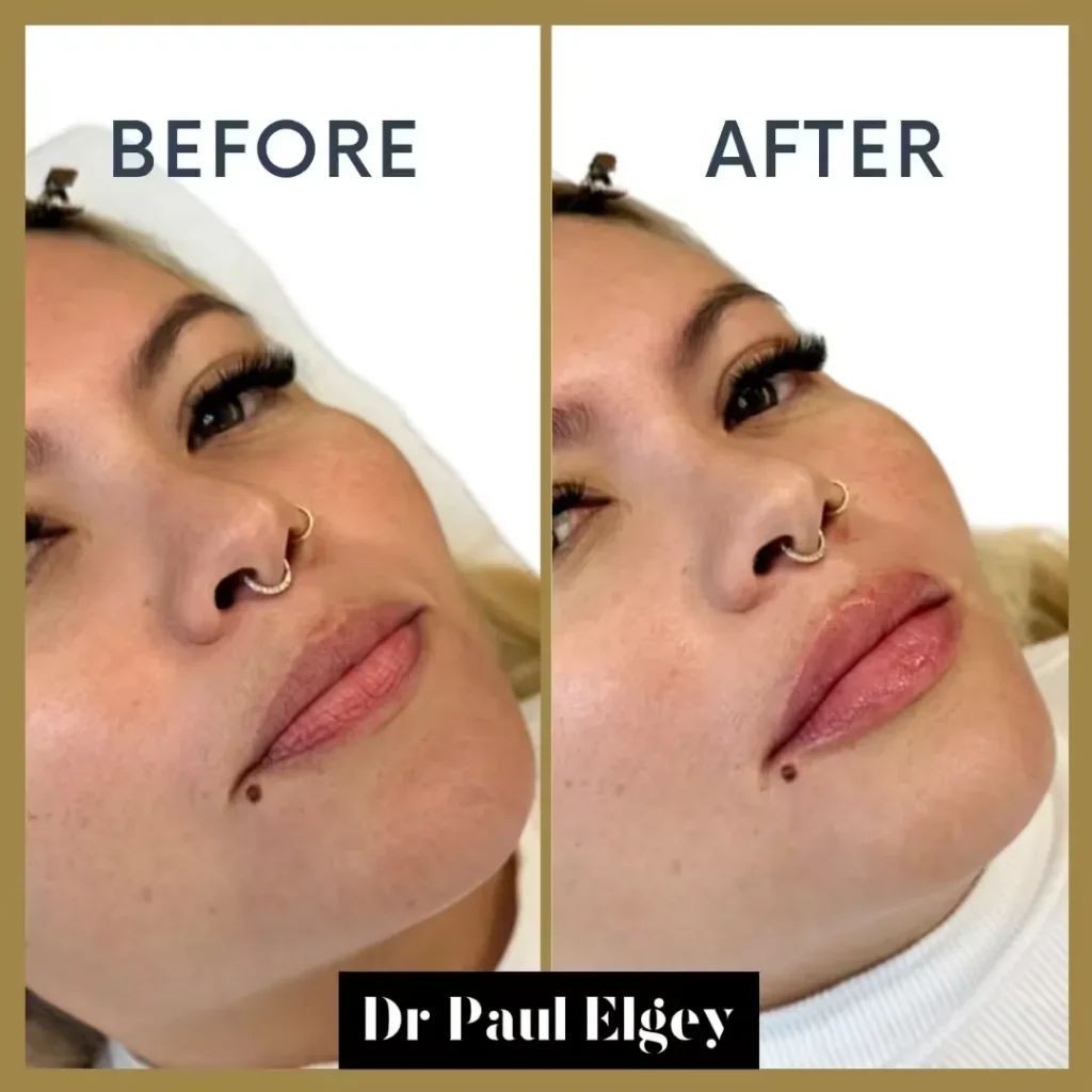 Lip filler before and after result by Dr Paul Elgey, London