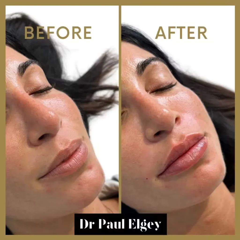 Lip filler before and after result by Dr Paul Elgey, London