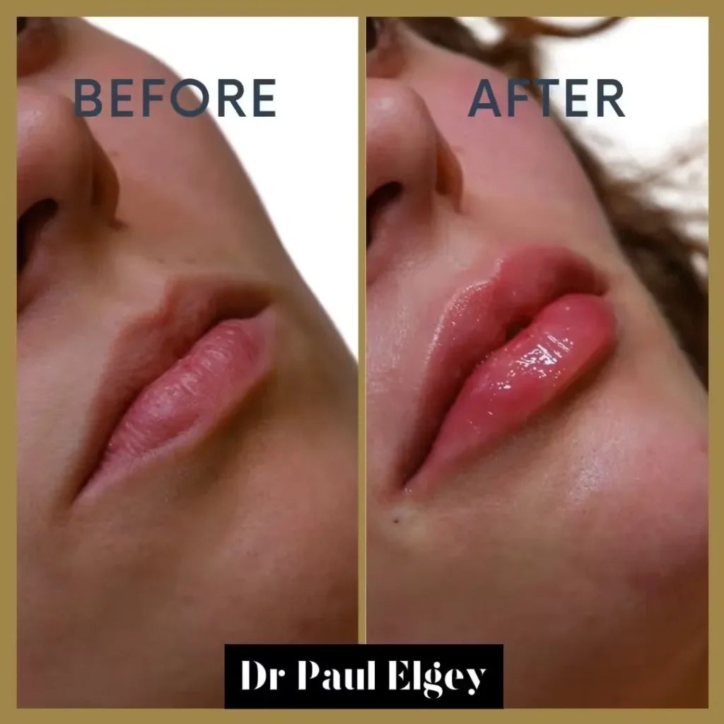 Lip filler before and after result by Dr Paul Elgey, London
