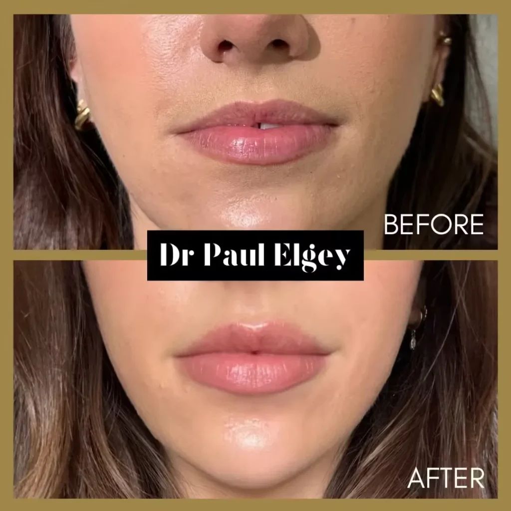 Lip filler before and after result by Dr Paul Elgey, London