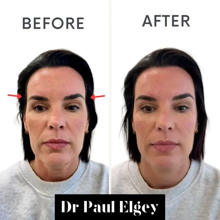 Temple filler before and after result by Dr Paul Elgey, London