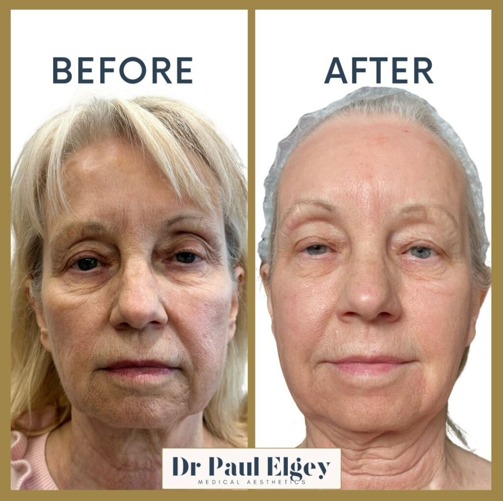 Before and after UltraClear laser treatment with Dr Paul Elgey, one week post treatment