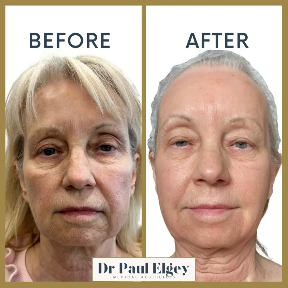 Before and after UltraClear laser treatment with Dr Paul Elgey, one week post treatment