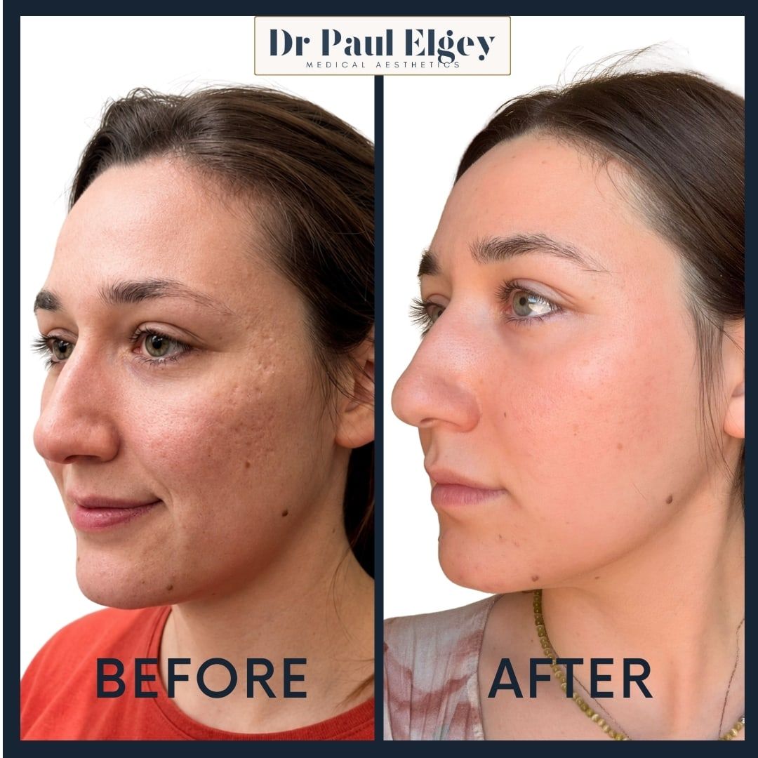 Before and after UltraClear laser treatment for acne scarring on the cheek, Dr Paul Elgey