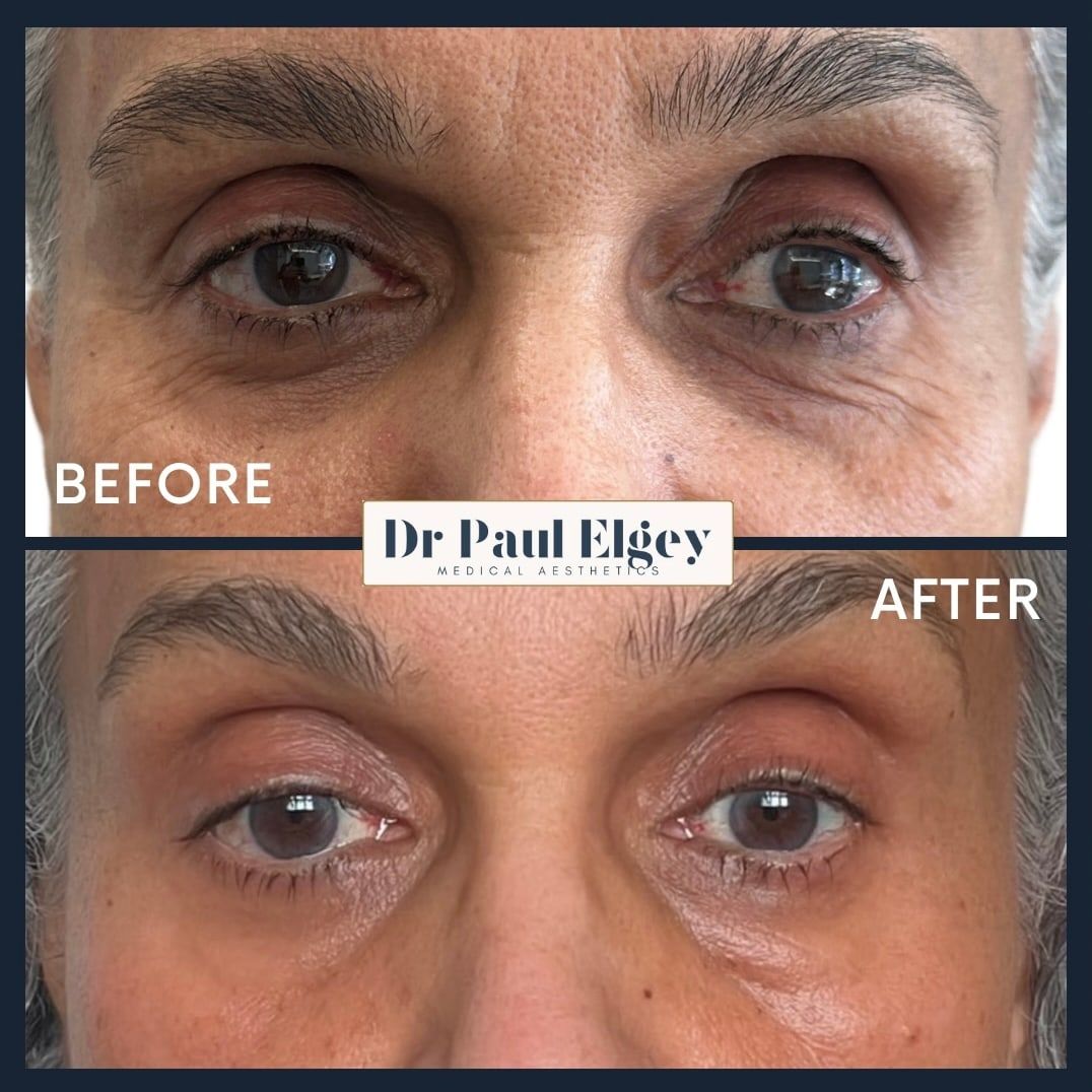 Before and after UltraClear laser treatment around the eyes, Dr Paul Elgey