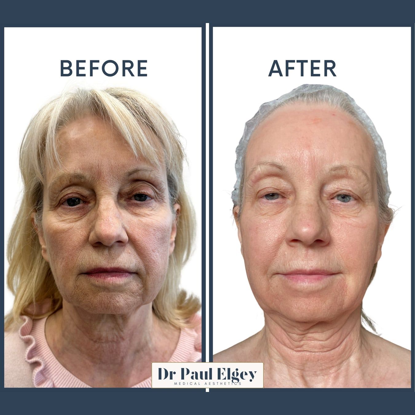 Before and after UltraClear laser treatment of the face and neck, Dr Paul Elgey