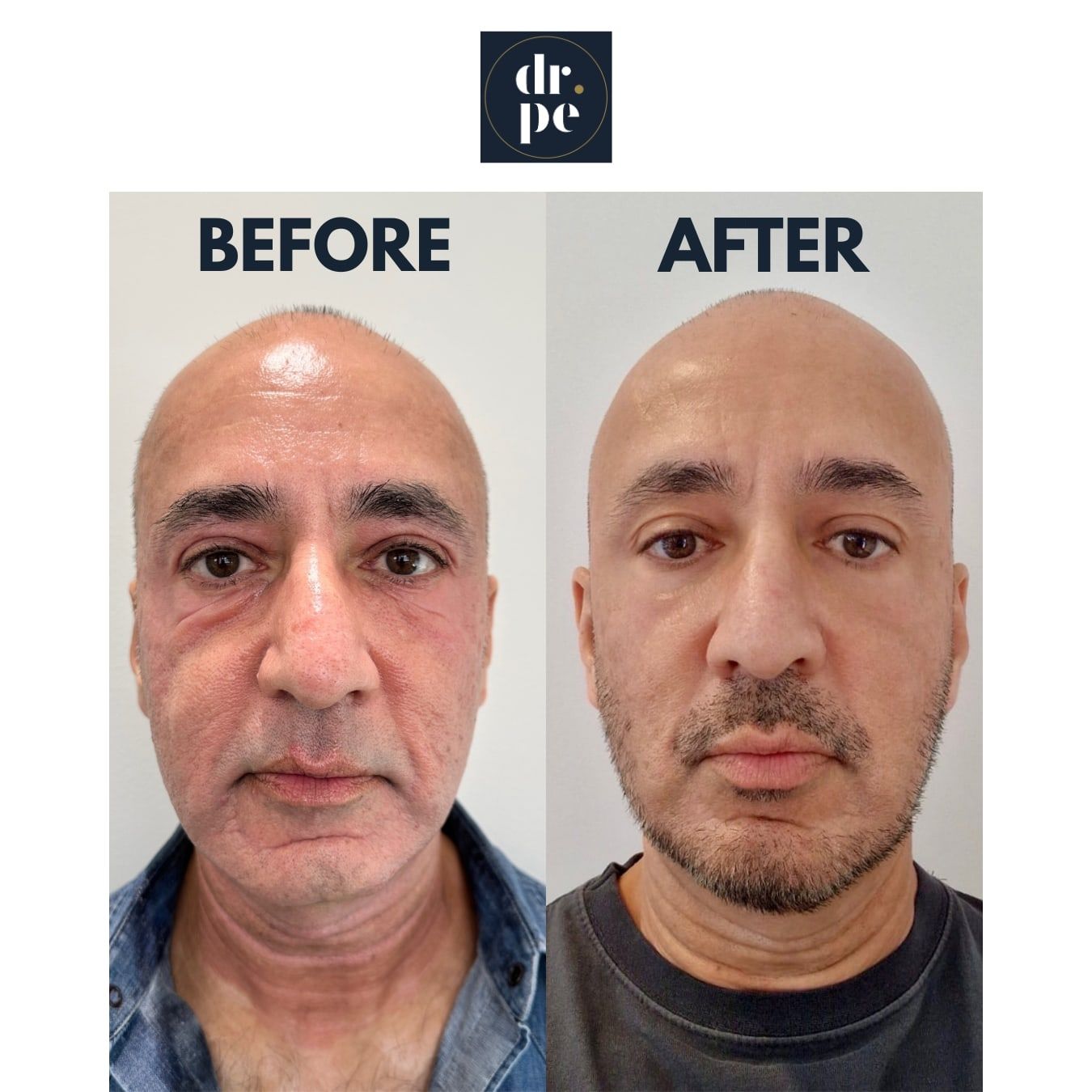 Before and after UltraClear laser treatment of the full face, Dr Paul Elgey