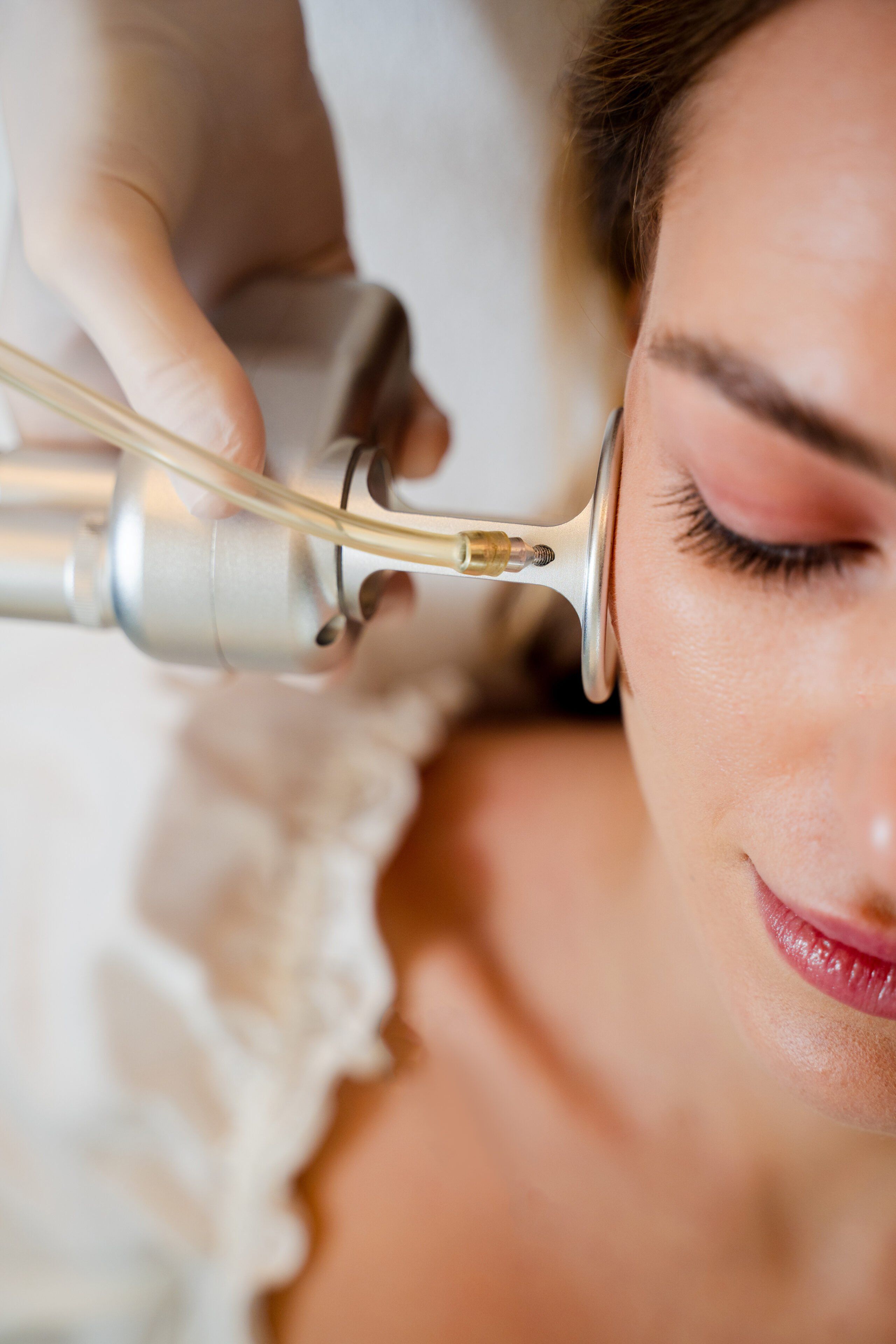 UltraClear laser being delivered along the cheek and jawline