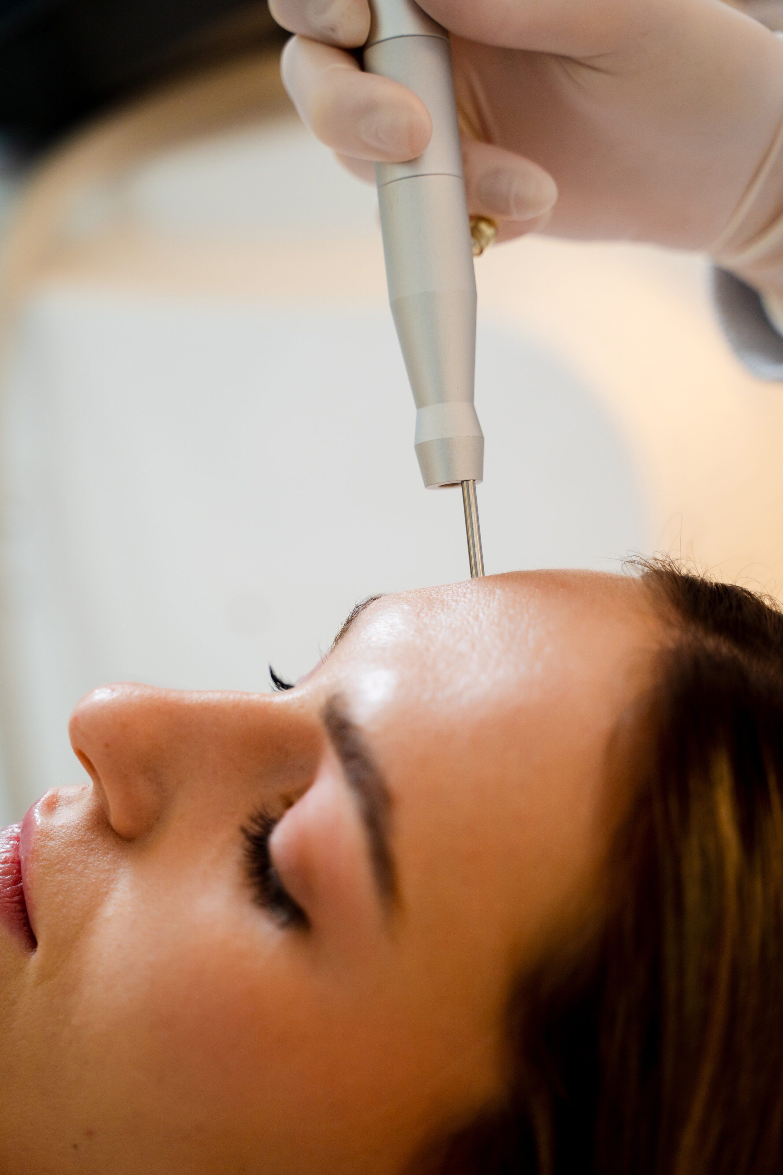 Clear mode resurfacing pass across the upper cheek