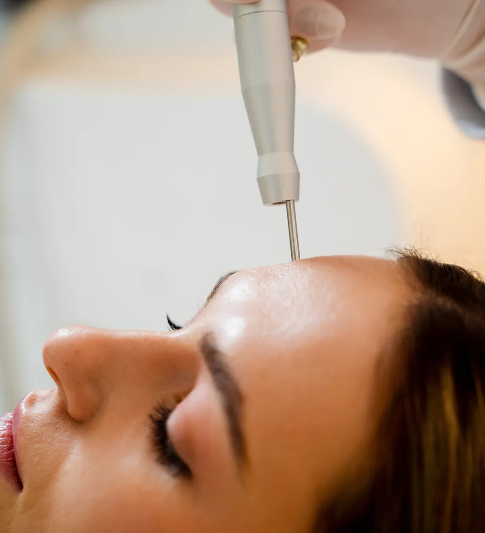 Clear mode resurfacing pass across the upper cheek