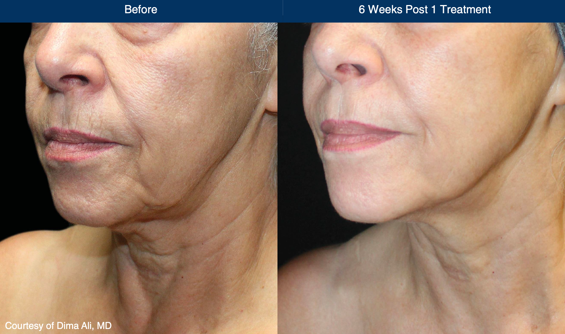 Laser coring: before and six weeks after one treatment. Case courtesy of Dima Ali, MD