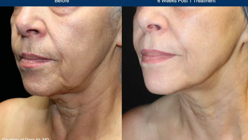 Laser coring: before and six weeks after one treatment. Case courtesy of Dima Ali, MD