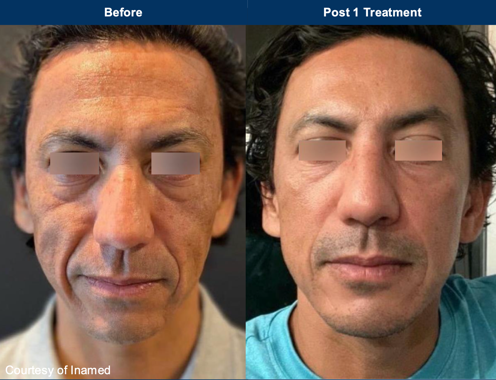 Ultra mode: before and after one treatment. Case courtesy of Inamed